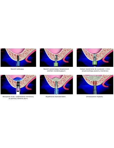 Zesatw do sinus lift Surgident Aqua Toca Kit