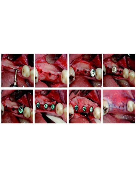 Ekspander kości Surgident Bone Expander kit