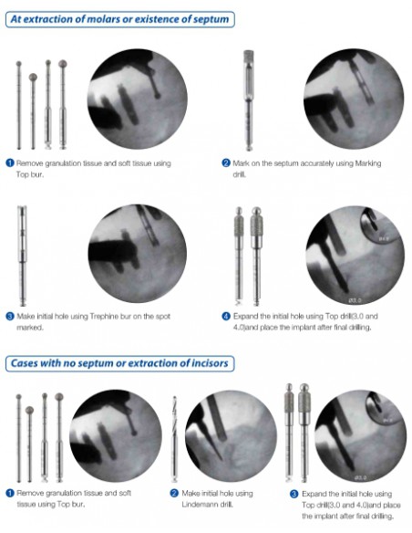 Surgident  Top System