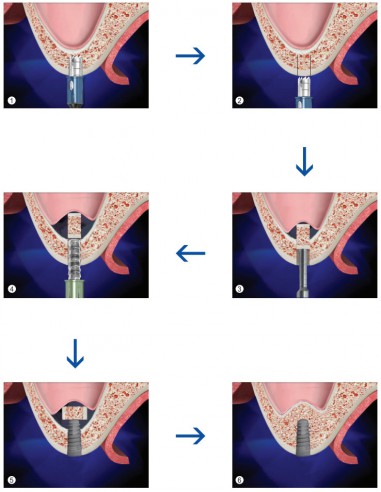 Surgident Easy Sinus KIT
