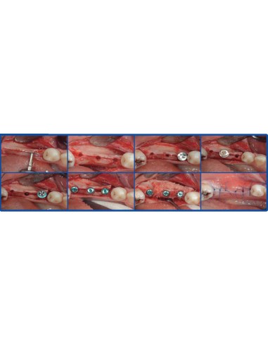 Surgident Bone Multi System