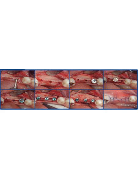 Surgident Bone Multi System