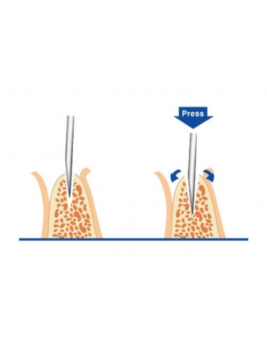 Surgident Ridge Split set